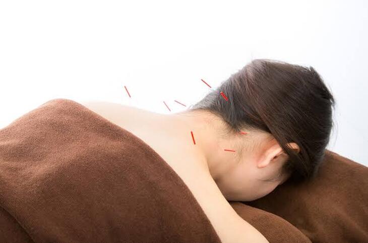 首こり改善の新提案、鍼灸とパーソナルトレーニングで身体をリフレッシュ！ | 神奈川県川崎のパーソナルトレーニングならPRODUCTION STUDIO iDeALMe川崎店